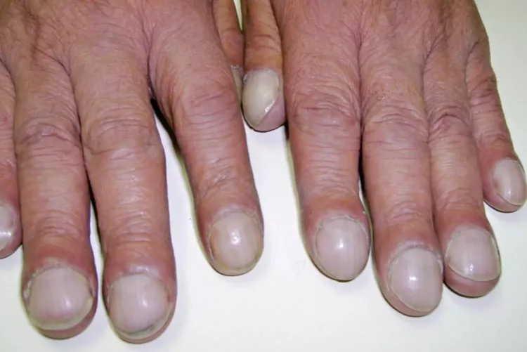 Ngón tay dùi trống có thể là dấu hiệu của ung thư phổi và các vấn đề tim mạch. Ảnh: Very Well Health