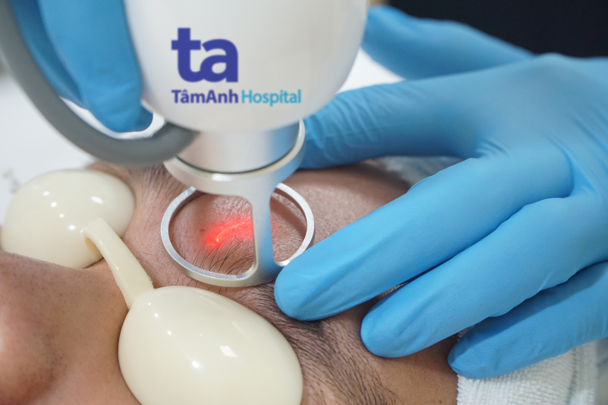 Điều trị sẹo rỗ ở trán cho một nam bệnh nhân bằng laser CO2 fractional. Ảnh minh hoạ: Bệnh viện Đa khoa Tâm Anh