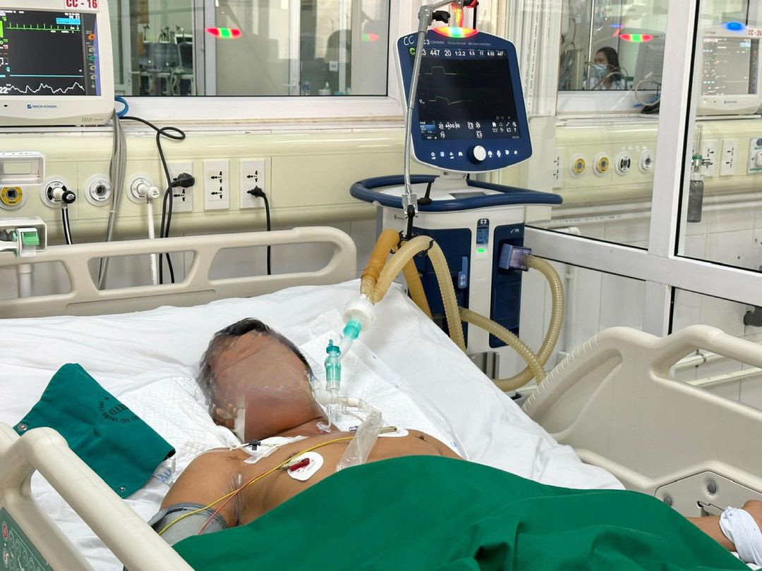 Người đàn ông nguy kịch, thở máy do mắc uốn ván sau khi cắt trĩ tại nhà - Ảnh: BVCC Tin tức sáng 1-8: Mùa Vu lan đi cáp treo núi Bà Đen được giảm 50% vào buổi tối- Ảnh 5.