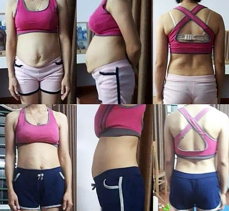 Một bệnh nhân không thừa cân nhưng béo bụng mắc nhiều bệnh lý. Ảnh: Bác sĩ cung cấp